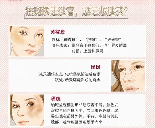 黄褐斑与雀斑