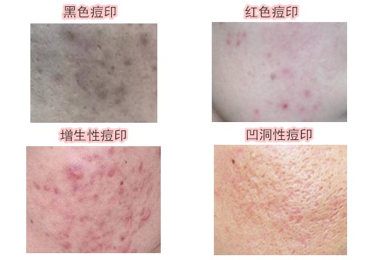痘痘类型