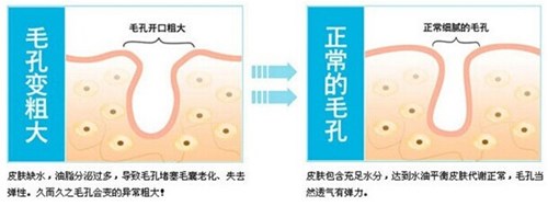 毛孔粗大