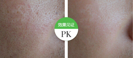 毛孔对比