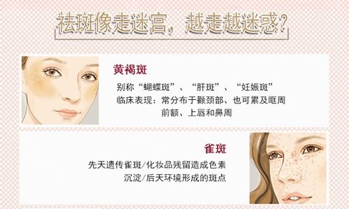 黄褐斑 雀斑