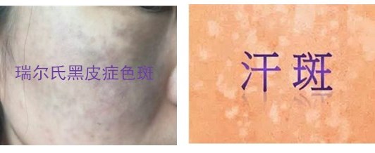 汗斑  黑色斑