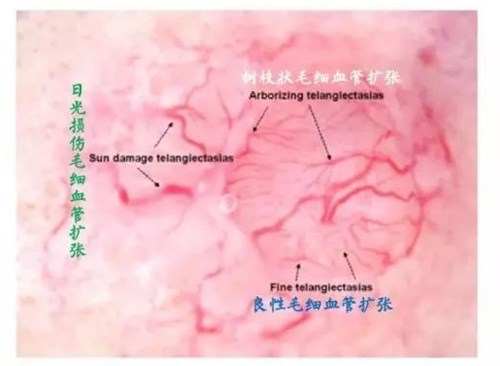 激素扩张