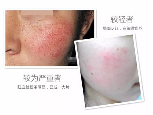 红血丝治疗