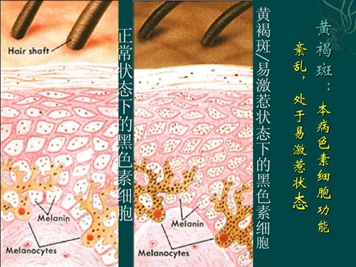 黄褐斑产生的原因