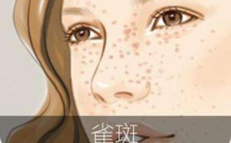 雀斑形成原因