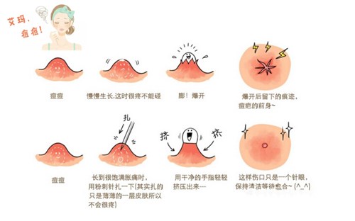 专业挤痘