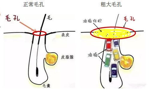 毛孔堵塞