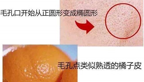毛孔像橘皮