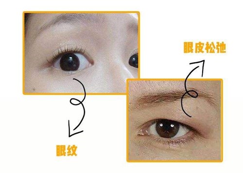 眼部皮肤松弛