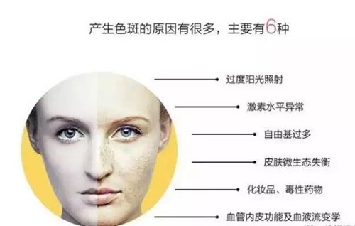 激素过多产生雀斑