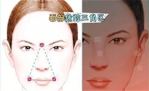 面部危险三角区