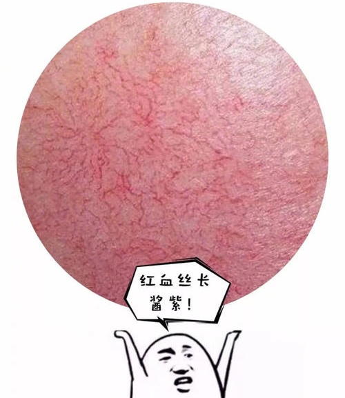 红血丝是什么