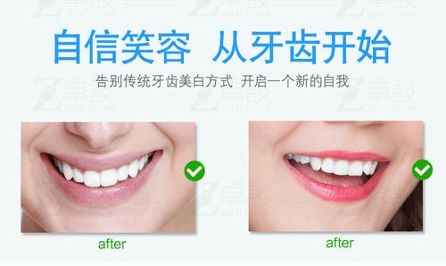 牙齿美白