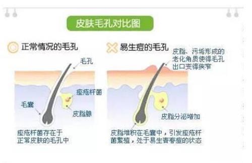 毛孔粗大原因
