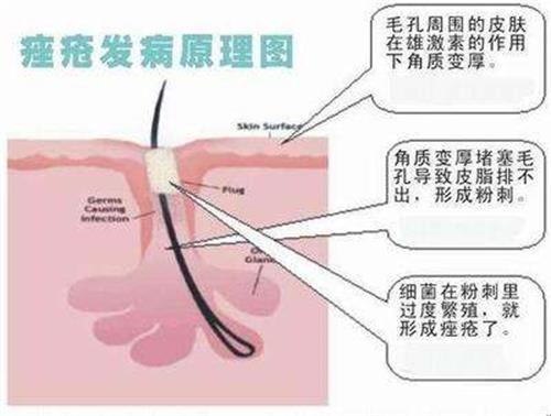 痤疮形成原理