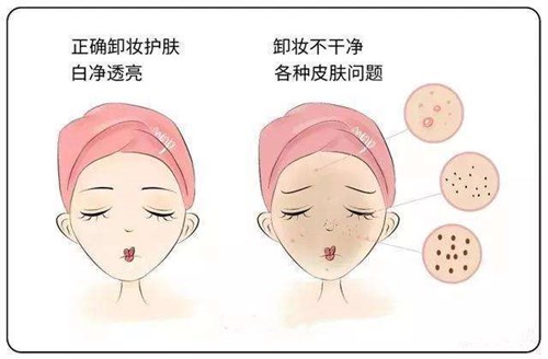 正确卸妆