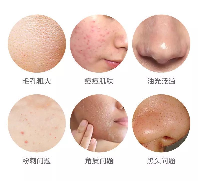 痘痘类型