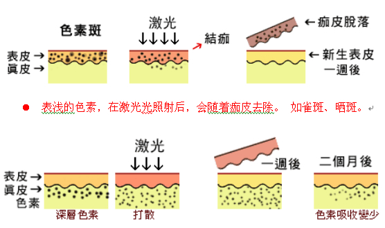 激光祛斑原理