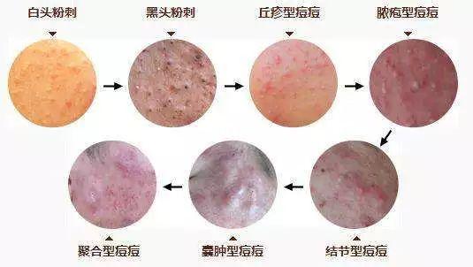 痘痘形成