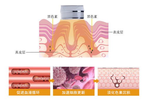 光子嫩肤原理