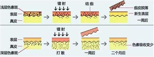 激光祛斑原理