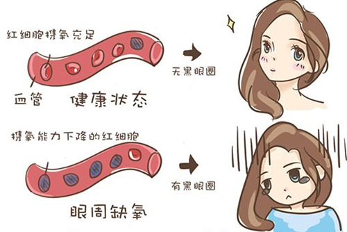 黑眼圈形成原因