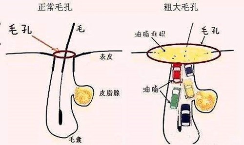 毛孔堵塞