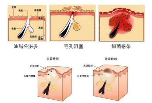 油脂分泌旺盛
