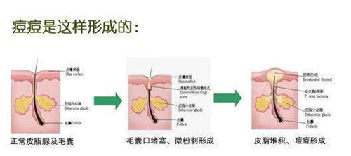 痘痘形成