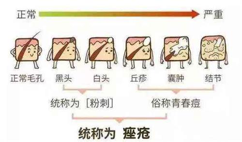 痤疮形成