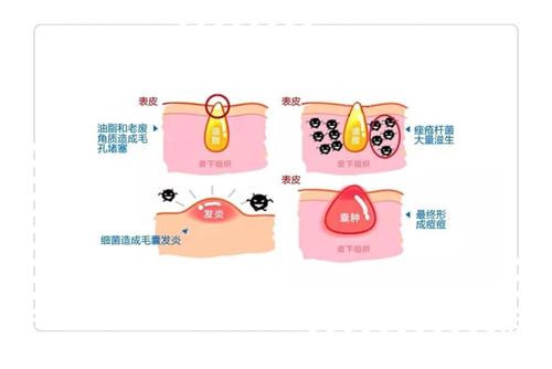 闭口粉刺