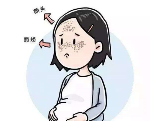 孕期产生黄褐斑
