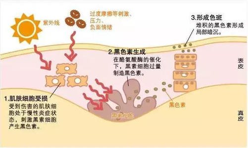 色斑形成
