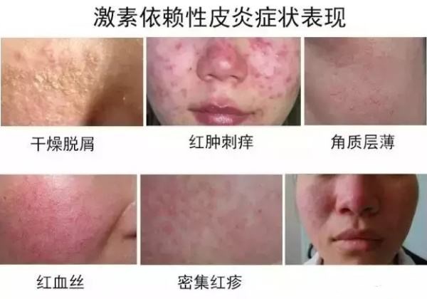 激素脸