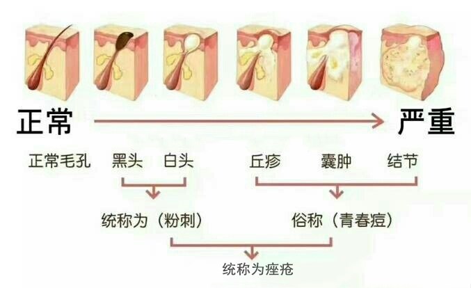 痘痘的产生
