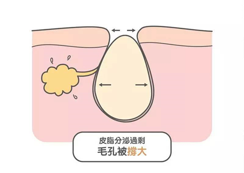 毛孔粗大是什么原因