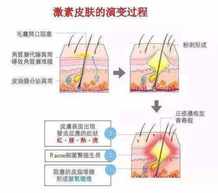 激素性皮肤的演变过程