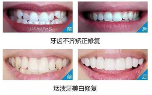 树脂美牙贴面，解决牙齿困难