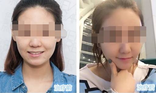 书颜世家皮肤管理——热玛吉效果